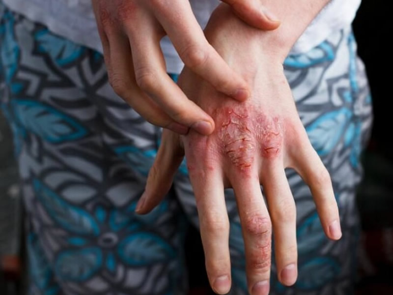 Auto Immune Diseases